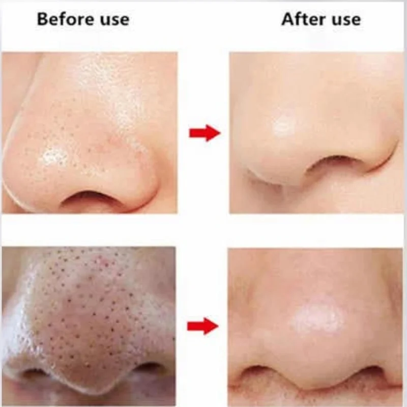 FPLS-001 blackhead remover with interchangeable treatment head